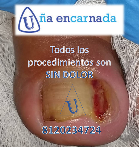 Podología Uña Encarnada